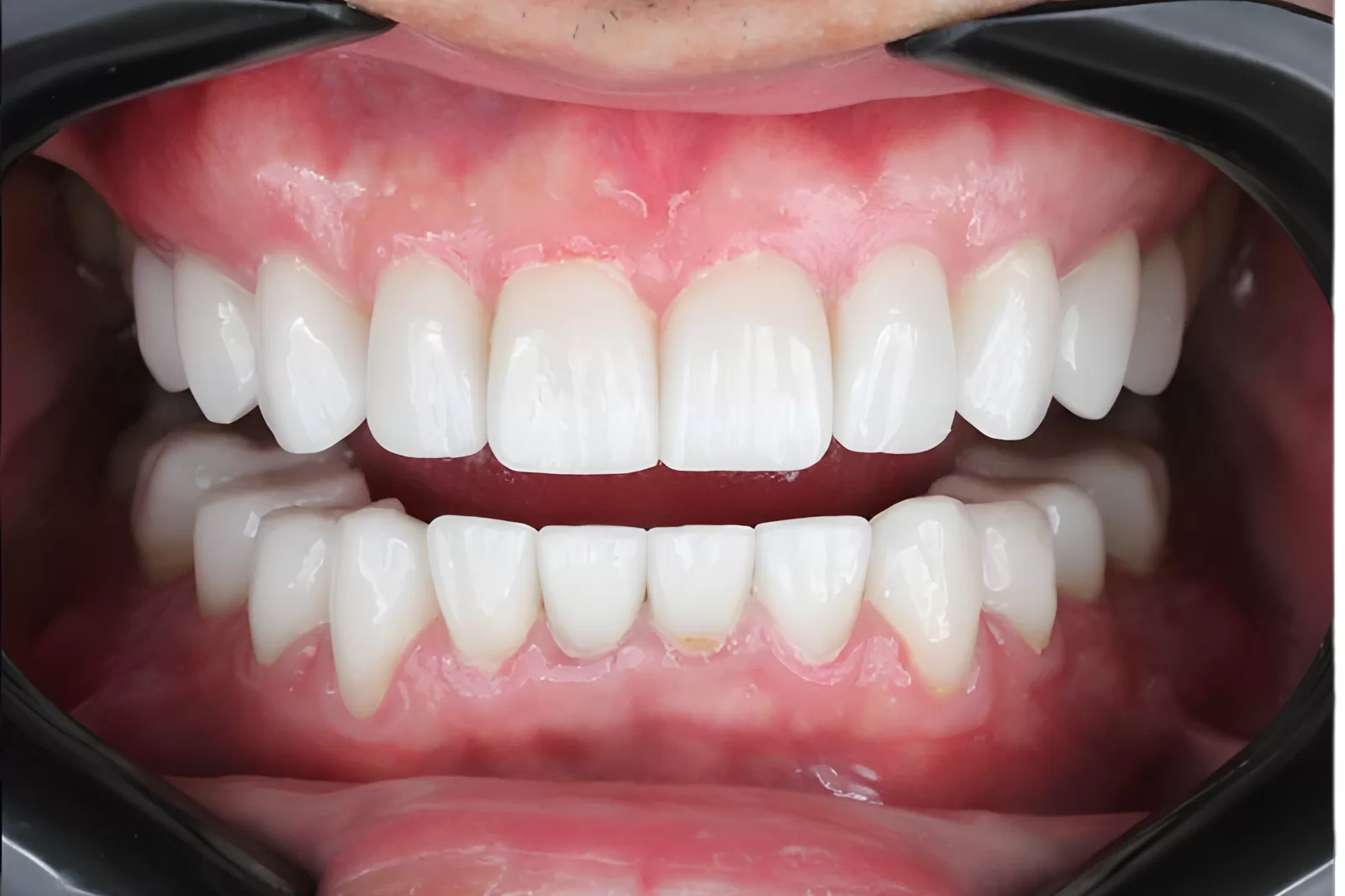 Resultado após o tratamento de lentes dentárias