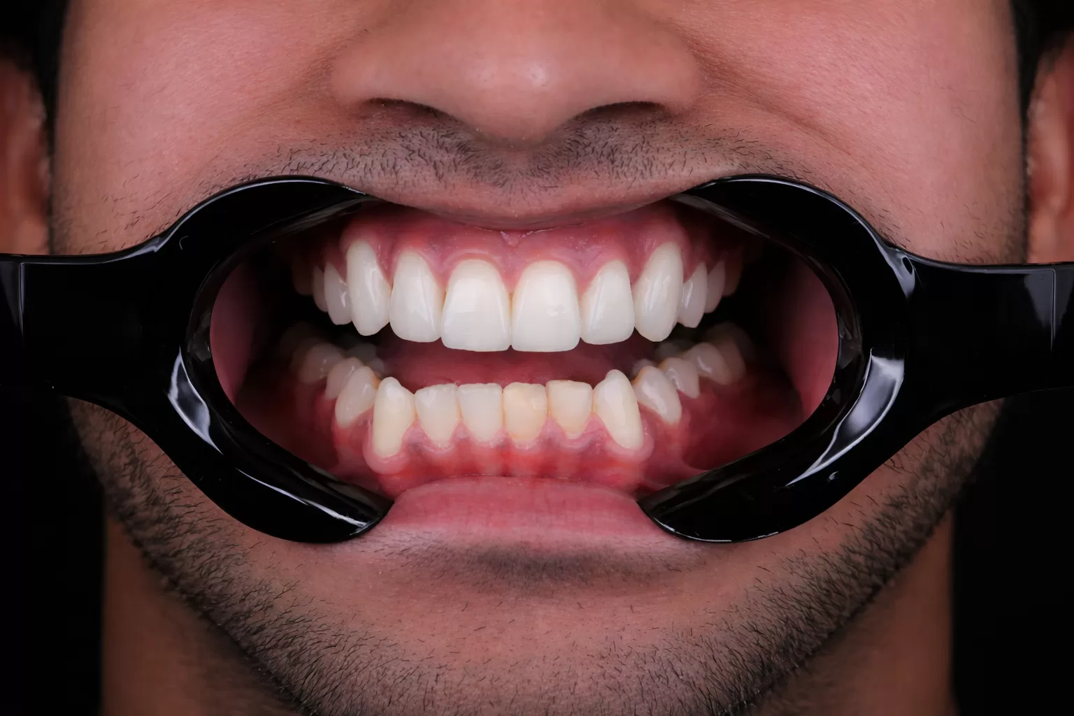Resultado após o tratamento odontológico